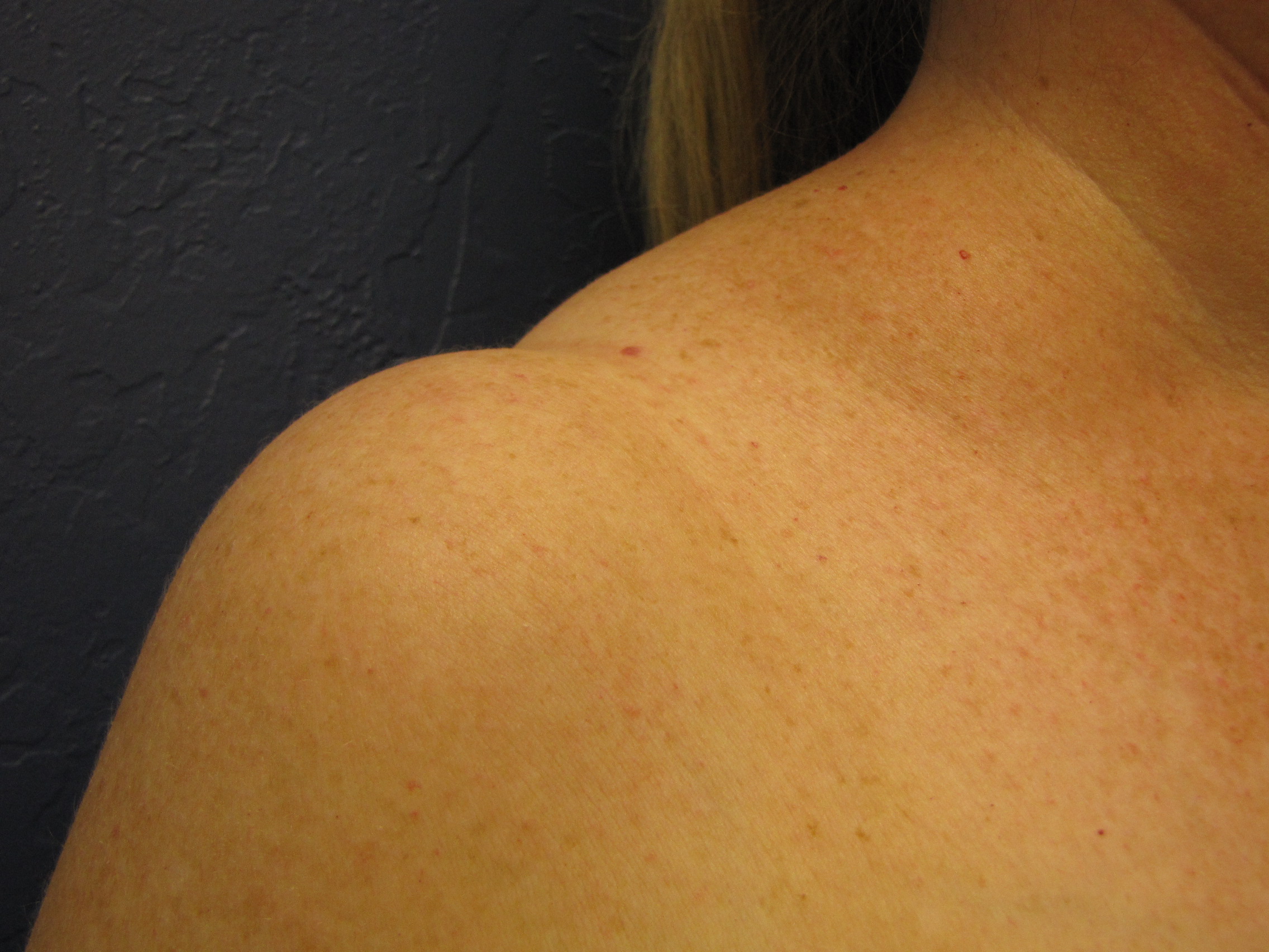 Breast reduction shoulder grooves Scottsdale Phoenix Arizona