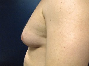 E) Left breast before surgery - side view