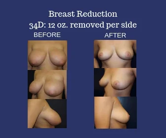 Breast Reduction 34D Before and After Photos
