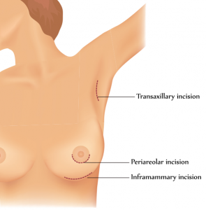 Drawing of breast augmentation incision locations (transaxillary, periareolar, and inframammary)