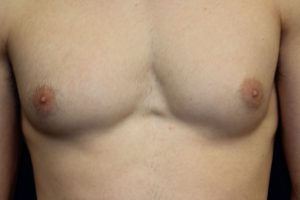 A. Gynecomastia