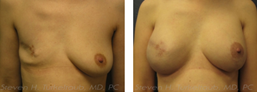 Breast Cancer and Implants Before and After Photos
