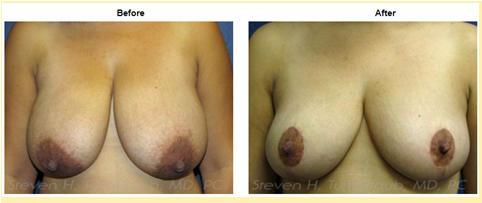 Breast Reduction Before and After Photos