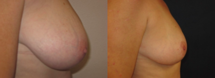 Breast Reduction Before and After Photos