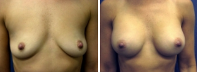 Photos of a patient of Dr. Turkeltaub before and after breast augmentation.