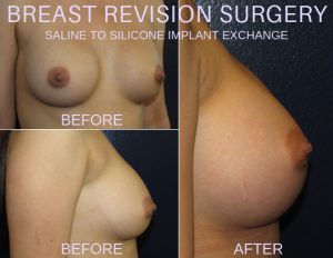 Breast Revision Before and After Photos