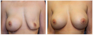 Deflated Saline Breast Implant Repair Before and After