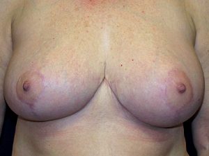 After Breast Reduction Surgery