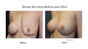 before-and-after-breast-revision-arizona-