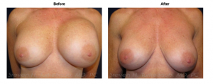 turkeltaub-watermark-breast-revision-6-img-blog