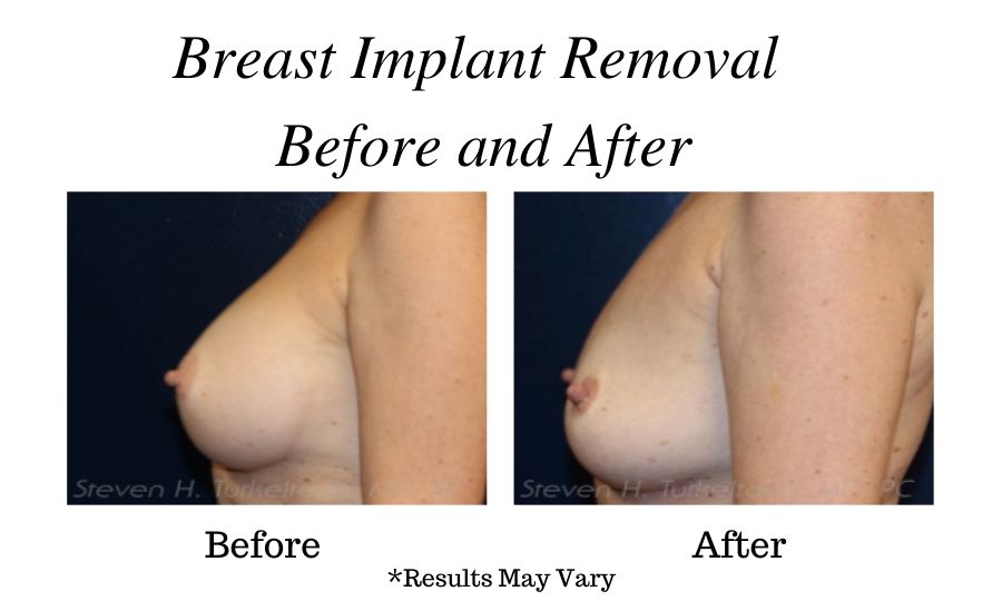 A before and after image of a woman who underwent breast implant removal to downsize her chest profile.