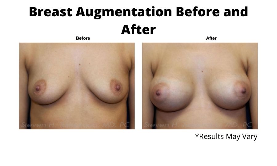 Before and after image showing the results of a breast augmentation performed in Scottsdale, AZ.