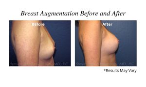 Before and after image showing the results of a breast augmentation in Scottsdale, AZ.