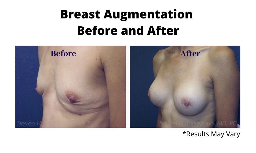 Before and after image showing the results of a breast augmentation in Scottsdale, AZ.