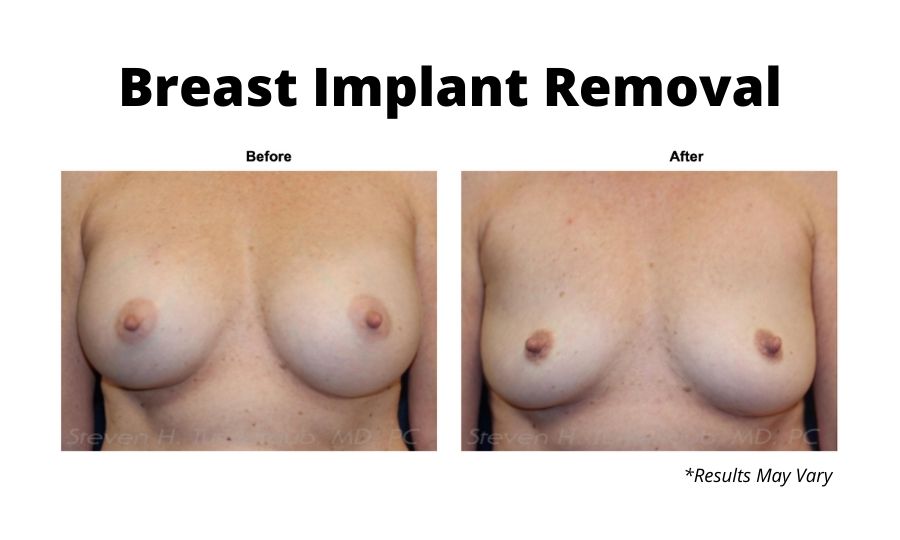 Before and after of a breast implant removal