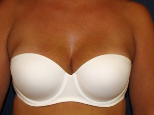 Breast Reconstruction AP bra