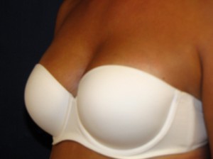 After breast reconstruction - Oblique view in bra