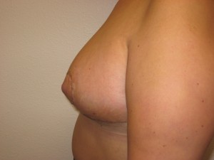 Immediately following breast reduction - Side view