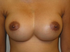 Symmastia of breasts