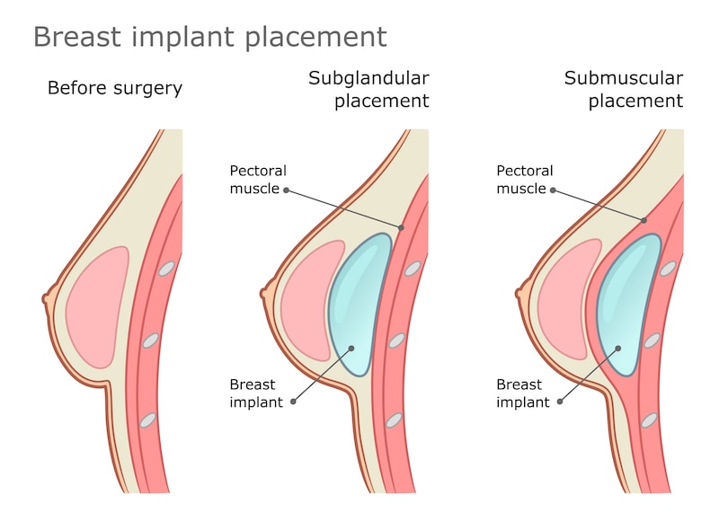 What Are the Advantages of Submuscular Breast Augmentation?