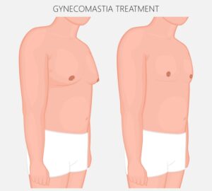 Vector illustration showing the before and after possibilities of male breast reduction.