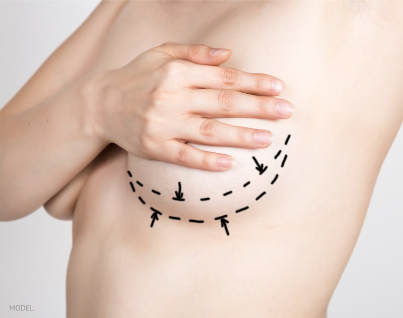 Shirtless woman with her hand covering her bare breast. Surgical lines drawn beneath the breast to show plastic surgery breast enhancement plan.