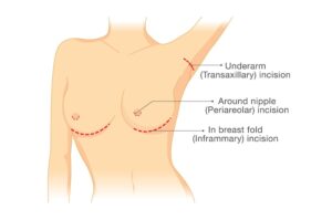 Illustration showing breast augmentation incision options