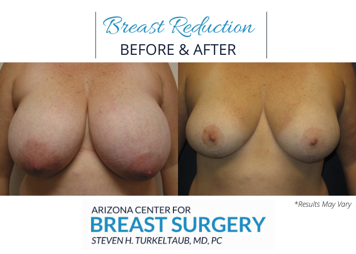 Before and after image showing the results of a breast reduction performed in Scottsdale, AZ.