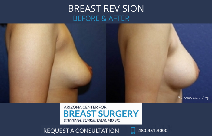Before and after image showing the results of a breast revision performed in Scottsdale, AZ