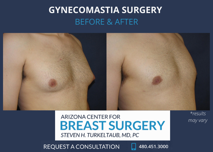 Before and after image showing the results gynecomastia surgery performed in Scottsdale, AZ.