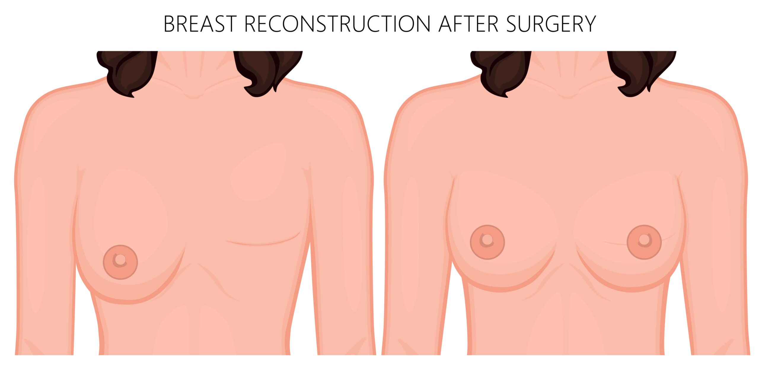 Illustration showing before and after breast reconstruction.
