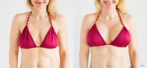 Model image showing potential results after breast lift and augmentation surgery.