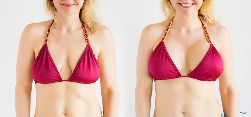 Model image showing potential results after breast lift and augmentation surgery.