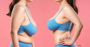Before and after breast lift results, side by side.