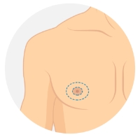 Concentric Circle (Periareolar) Mastectomy diagram