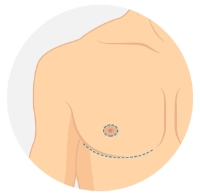 Double Incision Free Nipple Graft Mastectomy diagram