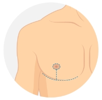 Inverted "T" Mastectomy diagram