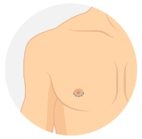 Keyhole Mastectomy diagram
