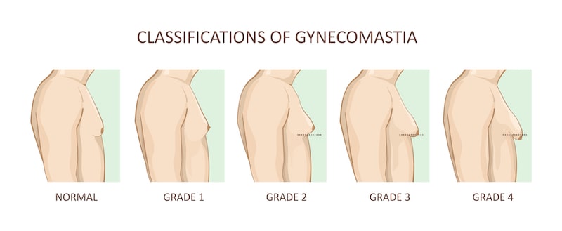Illustration of classifications of gynecomastia.