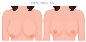 illustration of breast reduction and lift.