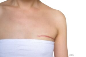 Woman with mastectomy scar.