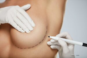 Plastic surgeon marking woman's skin before breast surgery