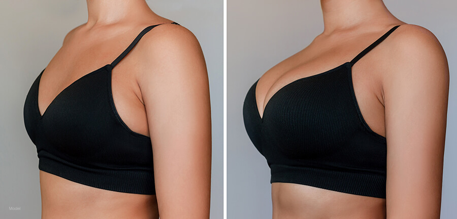 Profile photos of a woman in a black bra simulating before and after receiving a breast augmentation with a lift